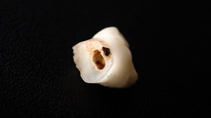 Nieuwe studie naar cariëspreventie pleit voor gecombineerde behandeling