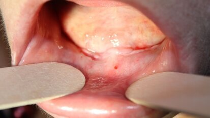 Leczenie  implantologiczne znacznego zaniku części zębodołowej żuchwy