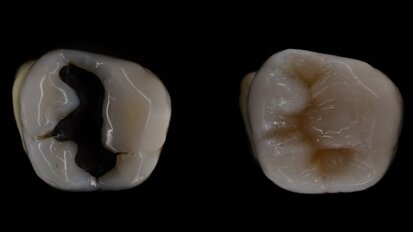 L'interdiction des amalgames avance à grands pas... Quelles sont les alternatives ?