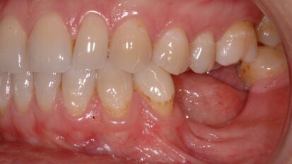 Soluzione di una grave atrofia ossea, orizzontale e verticale, con tecnica della lamina corticale