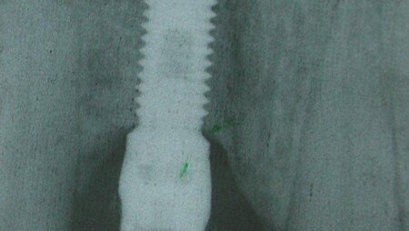 La Distrazione Alveolare. Interesse nel ripristino o la preservazione dell'estetica dei settori anteriori