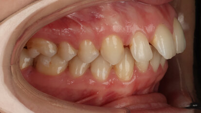 Torque control of maxillary incisors during space closure in a patient with maxillary protrusion treated with aligners in nine months