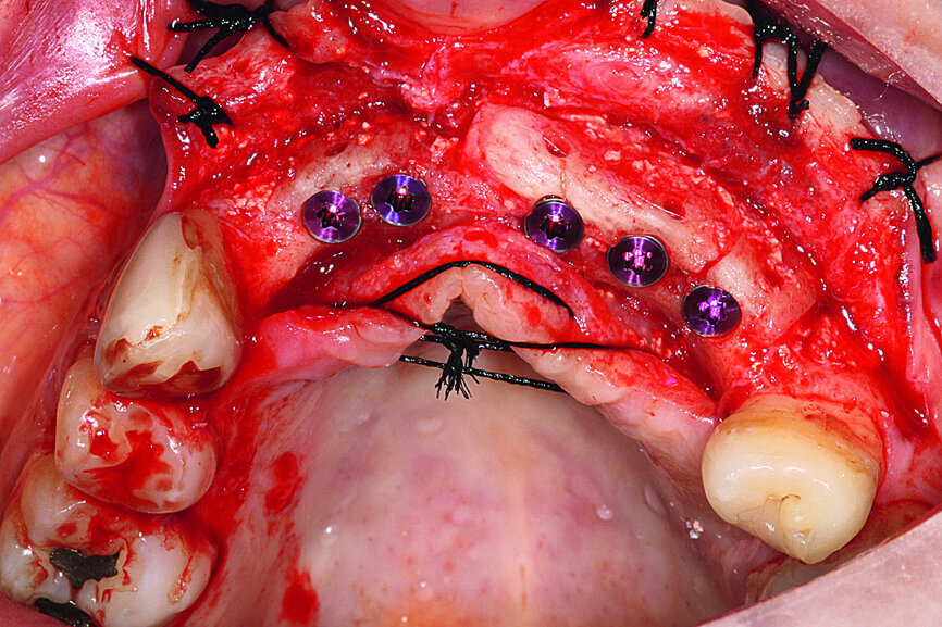 Fig. 16: All five implants equipped with threaded cover screws and the surrounding tissue sutured.