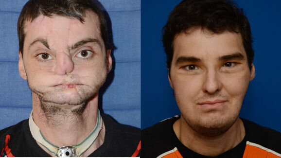 Greffes du visage : des chercheurs examinent les développements au cours des neuf dernières années