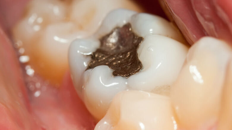 Sul tema “amalgama” aggiornamenti, prospettive ed implicazioni legali