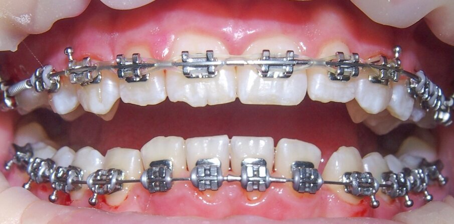 Fig. 5 - Dopo la pulizia con la polvere PLUS, il paziente riacquista una bocca pulita.