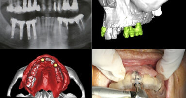 Precisión en cirugía guiada por ordenador