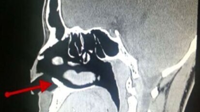 Tand groeit in neusholte