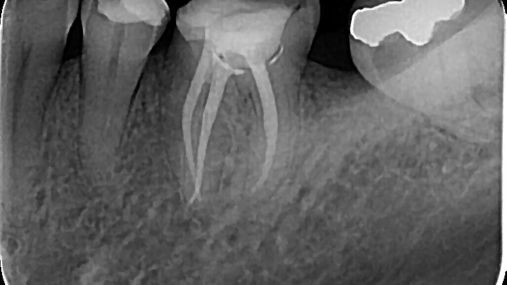 Mašinska preparacija kanala korena: kontinuirana rotacija ili recipročna kretnja  - postoji li dilema?