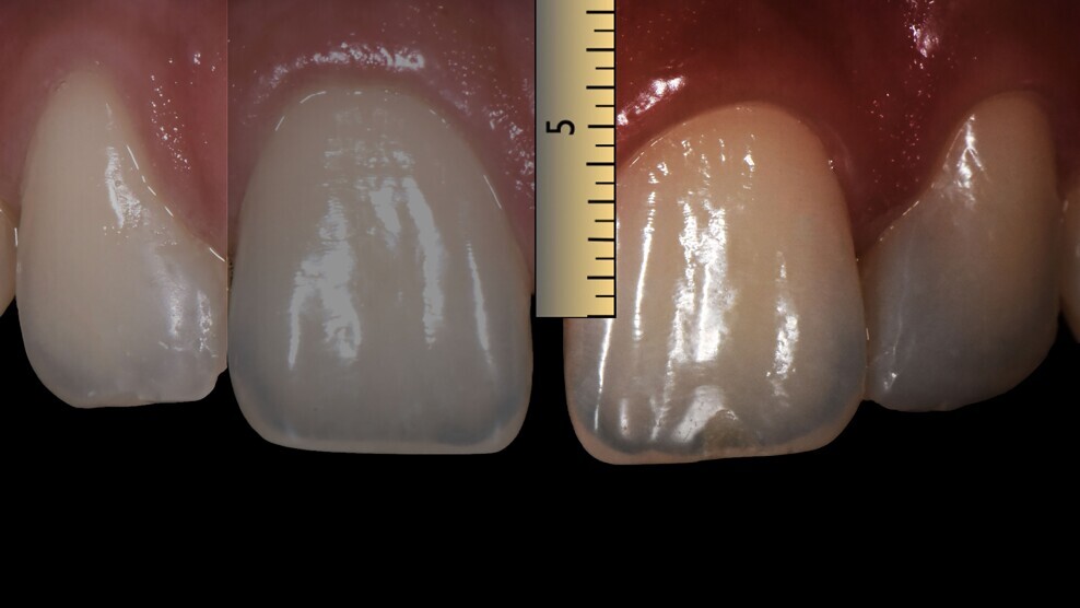 Fig. 3: Assessment of the distance between the contact point and the bone crest.