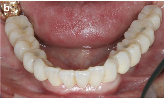 Fig. 14b: Occlusal, frontal and lateral views on the day of delivery, showing healthy peri-implant mucosal conditions (a) and the final CAD/CAM restoration in situ (b–e).