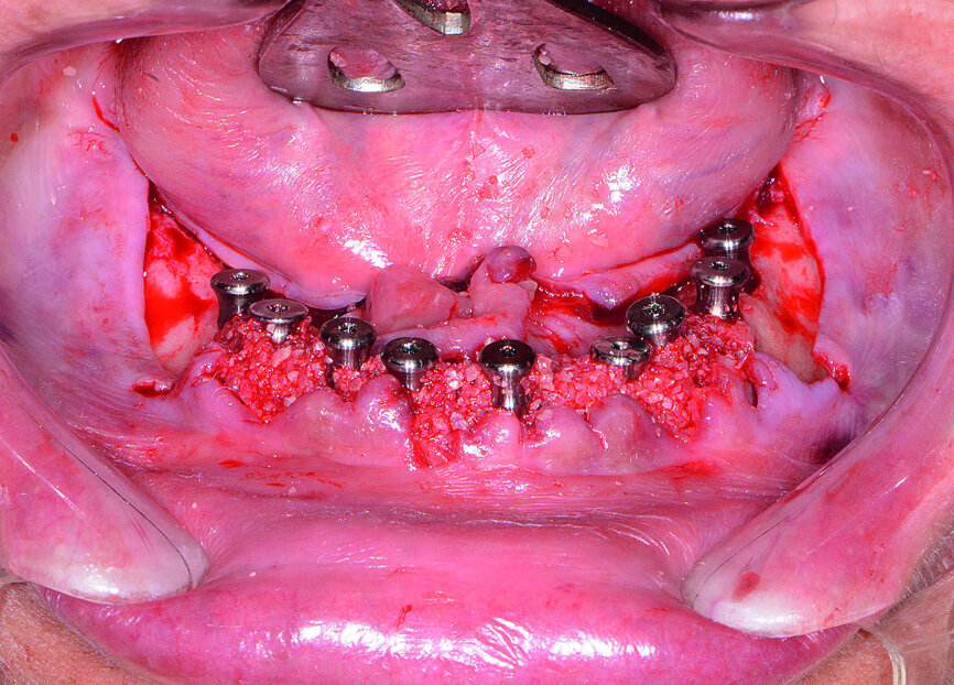 Fig. 15: Implants and healing caps with surrounding grafting.