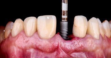 A fully digital approach to soft-tissue and aesthetic excellence