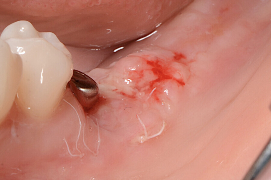 Fig. 15 : Situation dix jours après l’intervention, montrant une excellente cicatrisation des sites donneur et receveur. 