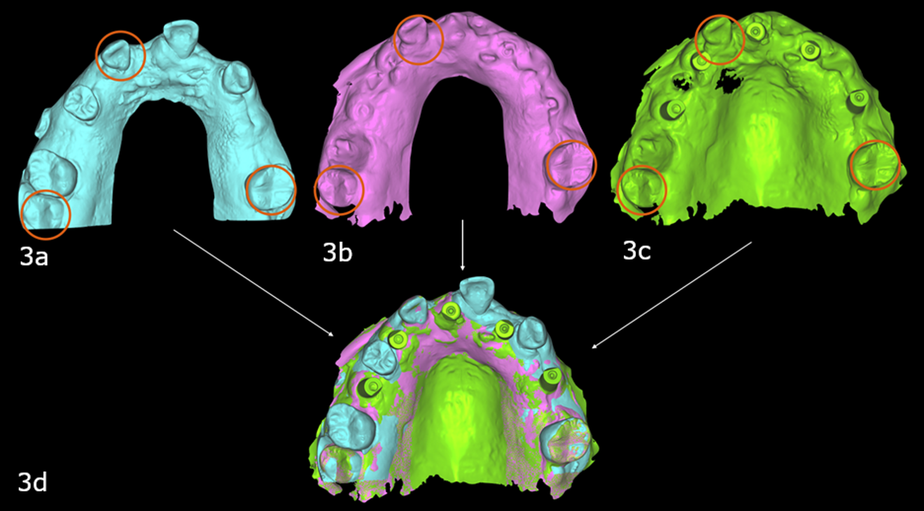 Figs. 3a–d: Selective extraction left three teeth as common points between the pre-op (a), interim (b) and implant intra-oral scans (c) to enable the software to merge the files, locating the implant scan in the same 3D space as the pre-op scan which had the wax-up.