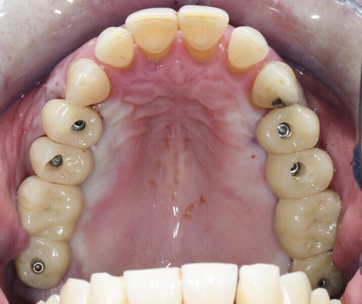 Fig. 4: Immediately placed temporary bridges