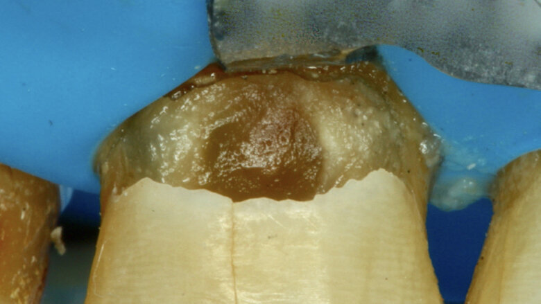 Figura 6. Remoción del esmalte sin soporte dentinario.
