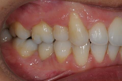 Figg. 6a-6d - Foto intraorali post-trattamento: visioni frontale (a), laterali (b), occlusali (c, d).