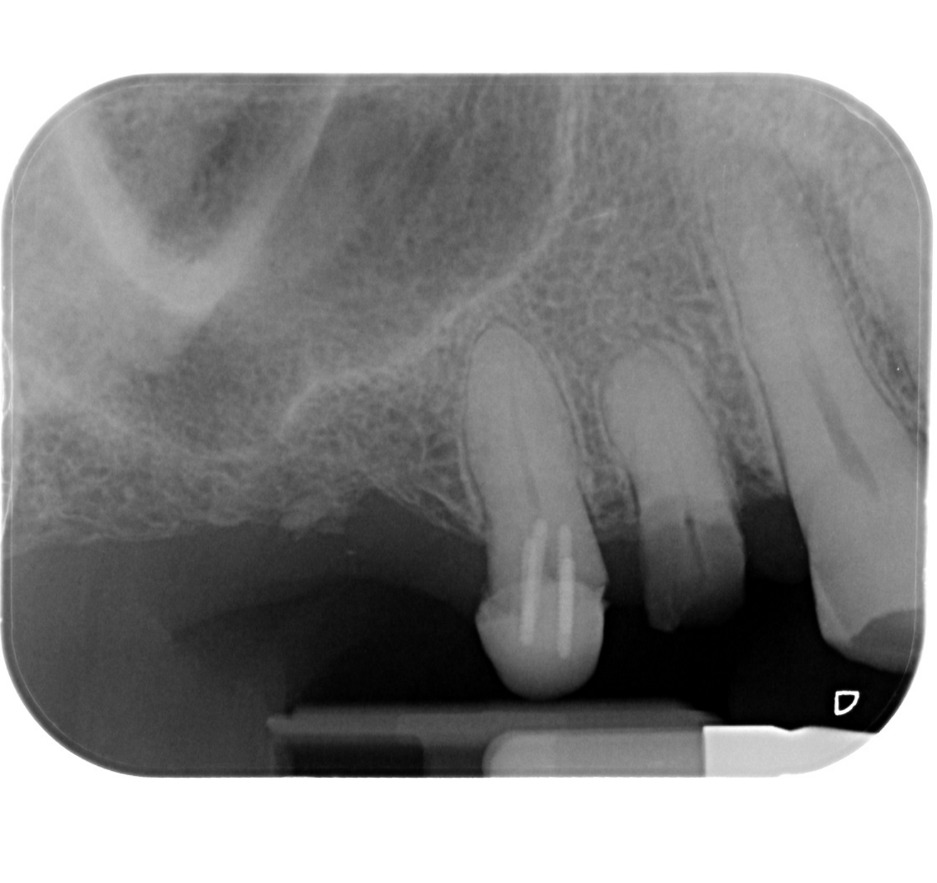 Fig. 3: Initial periapical radiograph.