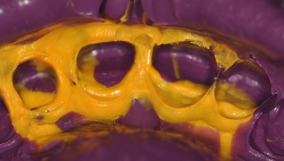 Fig. 7: Impression taken with Aquasil