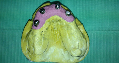 Edentulia risolta  con attacco monolaterale