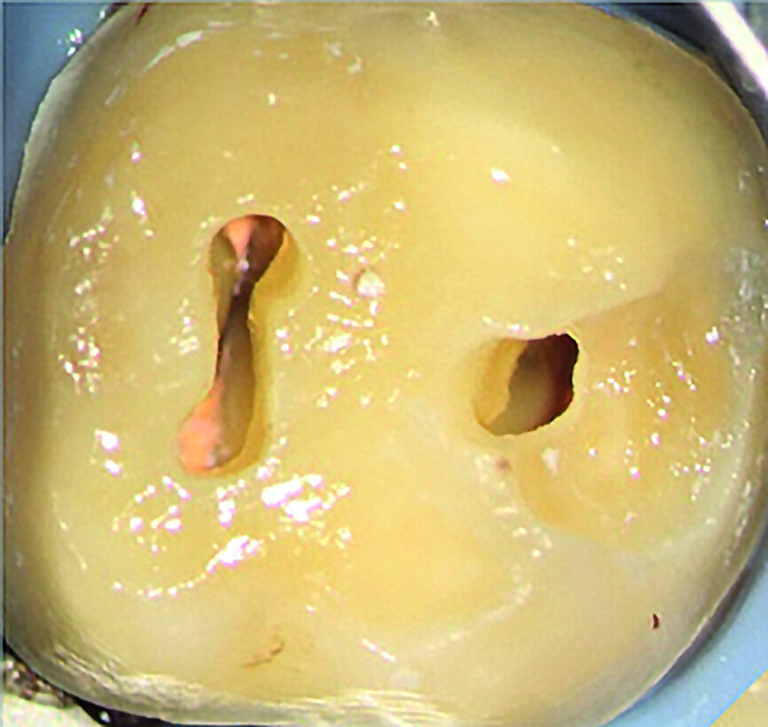 Figs. 4a et b : Cavités d’accès réalisées dans une molaire préparée pour une couronne et requérant un traitement canalaire (à gauche). Radiographie postopératoire (à droite) montrant le résultat admirable de la mise en forme du canal radiculaire, du nettoyage et de l’obturation – malgré la dimension minimale de l’orifice d’accès. À noter le plafond de la cavité pulpaire qui subsiste largement. (Photos : fournies par le Dr Steve Baerg) 