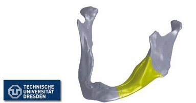 Erstes individuelles Unterkieferimplantat entwickelt