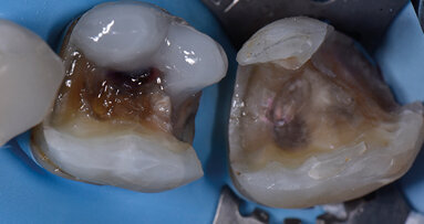 Restauri diretti complessi  in composito Ormocer nella  regione posteriore. Caso clinico