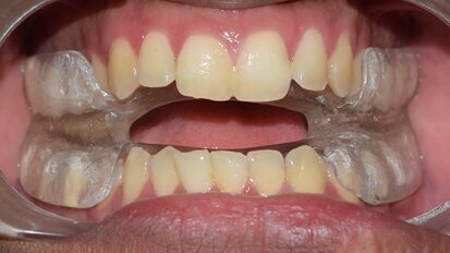 Management of Temperomandibular Joint disorders  and Obstructive sleep apnoea  in the dental office using TENS and k7 therapy