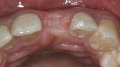 Pleidooi voor papilsparende incisies