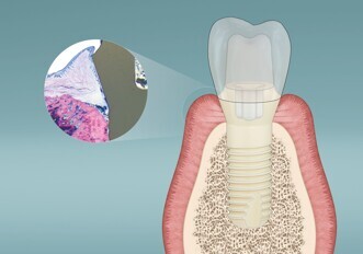 Patent Dental Implant System