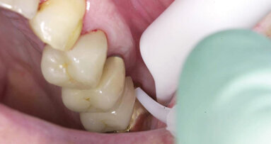 An introduction to lasers in dental hygiene