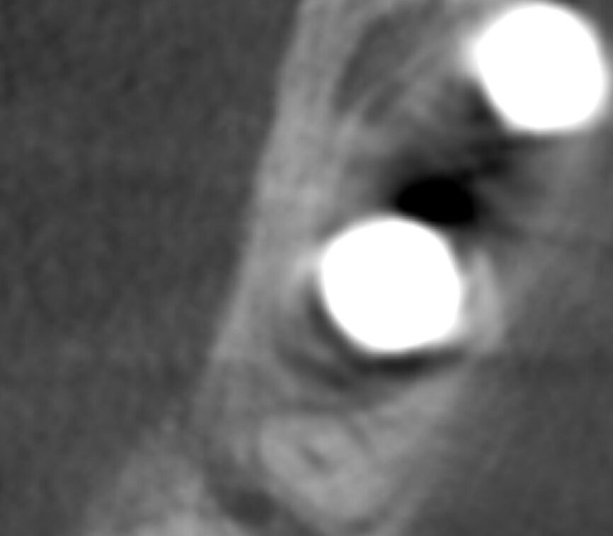 Fig. 12b: The two-year follow-up post-op CBCT scan.