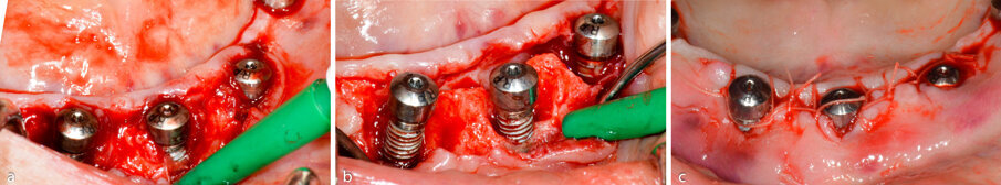 Figure 3a-c. Sequence of surgical therapy: Flap elevation revealing chronic inflammatory tissue; Debridement and decontamination of implant surface; and Defects filled with Bio-Oss and covered with Bio-Gide and mucoperiosteal flaps are repositioned and sutured.