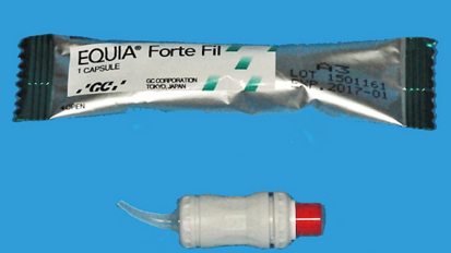 Las ventajas de los ionómeros de vidrio de alta viscosidad reforzados