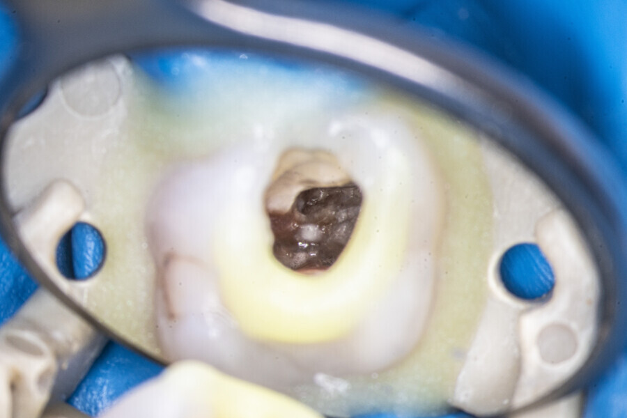 Fig. 40: Temporary build-up for increasing the amount of irrigant during the Less-Prep Endo enhanced irrigation protocol. The isthmus and the orifice of the MB2 canals could be seen.