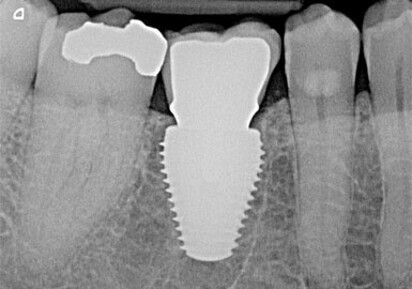 MAX ultra wide platform implants