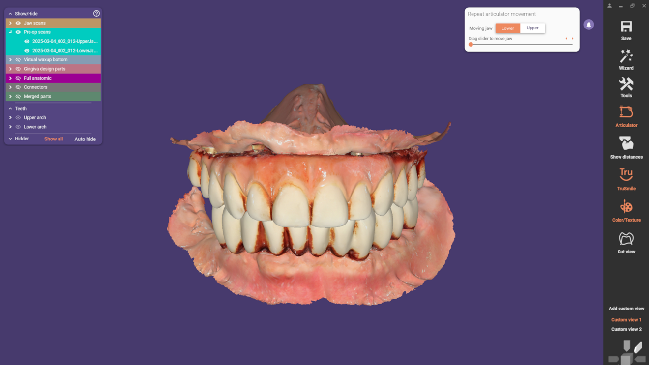 Fig. 15: Intra-oral scan of the provisional prostheses in function for 3.5 months.