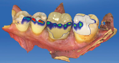 Vyfrézovat, vyleštit, nasadit! Nepřímé procedury ve stomatologickém workflow