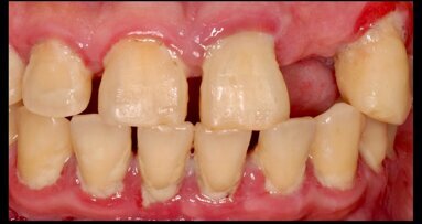 La xerostomía causada por medicamentos