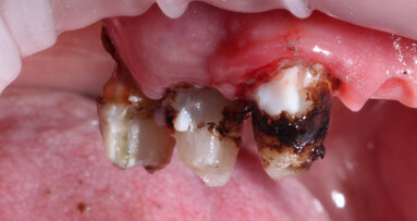 Comprehensive dental rehabilitation with a digital workflow: A case study