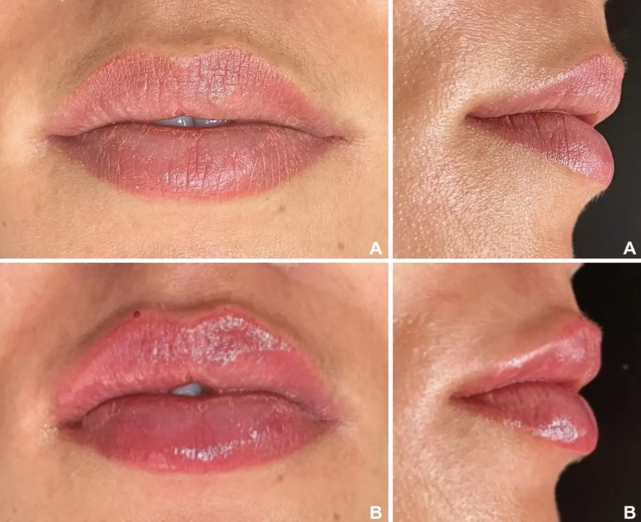 Patient from the group with thicker lips (a) before lip filling and (b) ten days after lip filling. (Image: De Queiroz Hernandez et al., licensed under CC BY 4.0)