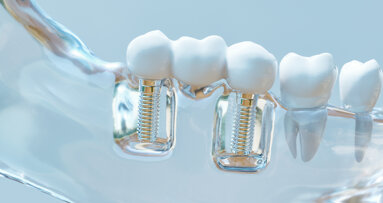 Titanium particles linked to antibiotic failure in peri-implantitis