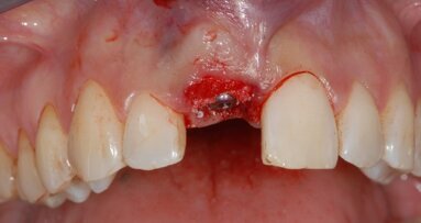 Impianto post-estrattivo e provvisorio immediato su incisivo centrale superiore di destra