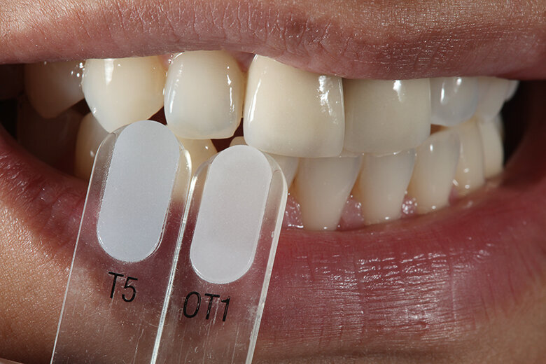 Fig. 4. Mediante las guías de color VITA VMK Master TRANSLUCENT se determinaron los matices cromáticos translúcidos.