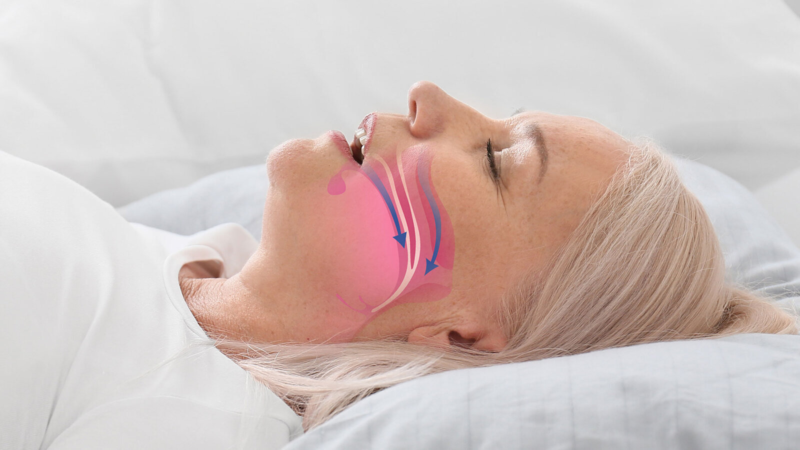 Diagnosi precoce dell’OSAS nella pratica clinica quotidiana: il ruolo dell’igienista dentale