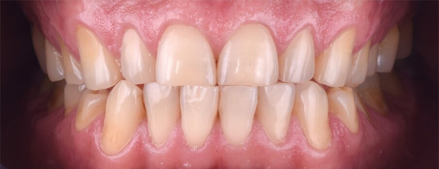 Obr. 2a–e: Úvodní intraorální fotografie.