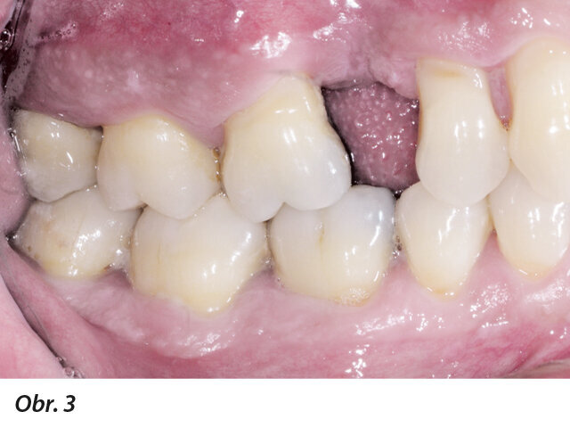 Obr. 1–5: Fotografi cká dokumentace počátečního stavu před parodontologickým ošetřením