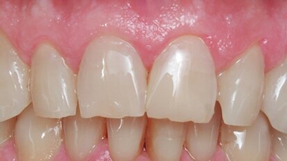 Figura 4. Caso terminado, imitando la naturaleza. Figura 4. Caso terminado, imitando la naturaleza.