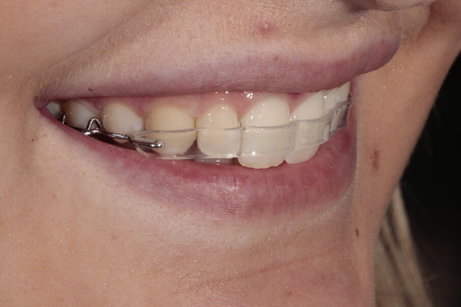 11. Behandeling met de Inman Aligner Super Slim